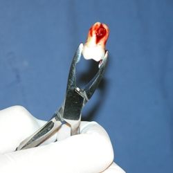 Photo of an extracted molar